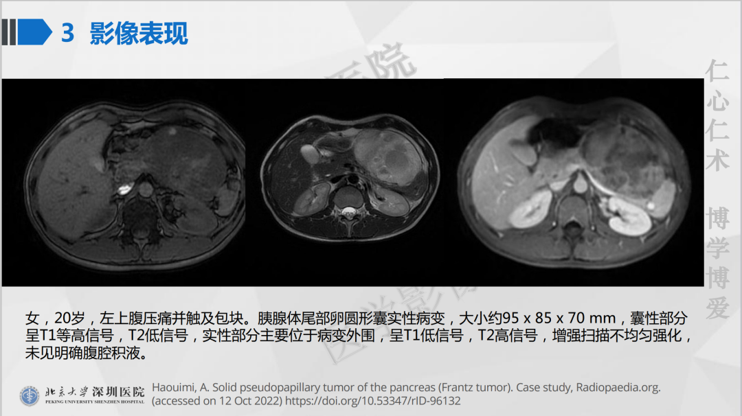 影像PPT - 【PPT】胰腺实性假乳头状瘤-26