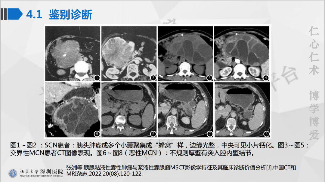 影像PPT - 【PPT】胰腺实性假乳头状瘤-31