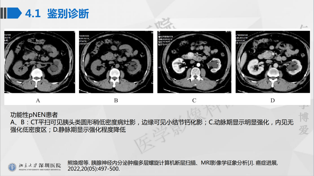 影像PPT - 【PPT】胰腺实性假乳头状瘤-33