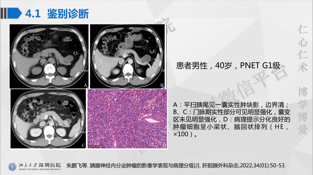 影像PPT - 【PPT】胰腺实性假乳头状瘤-34