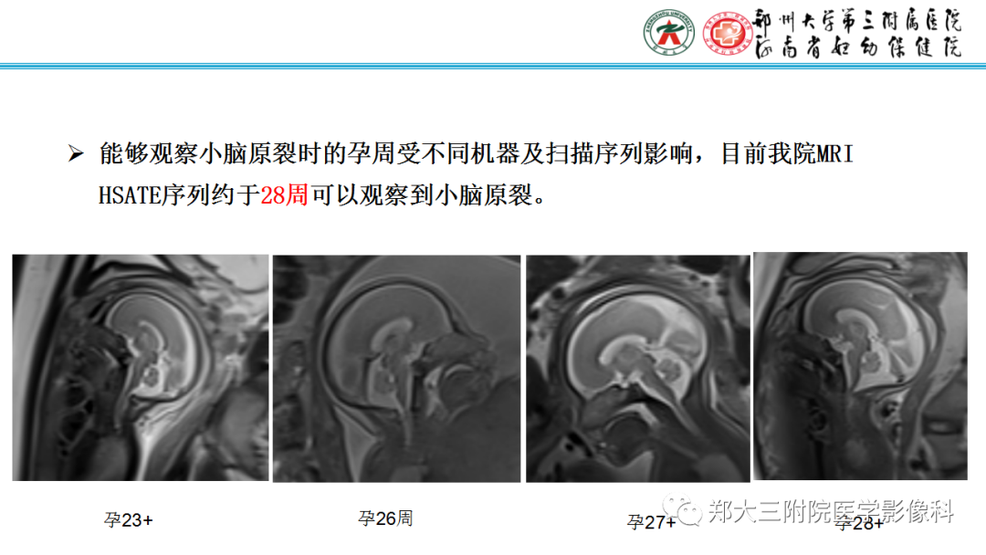 影像PPT - 【PPT】正常胎儿小脑胚胎发育及常见疾病异常发育过程-5