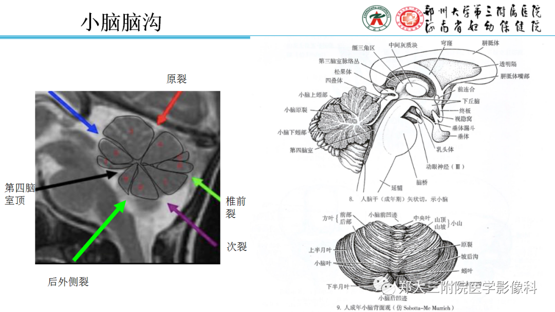 影像PPT - 【PPT】正常胎儿小脑胚胎发育及常见疾病异常发育过程-4