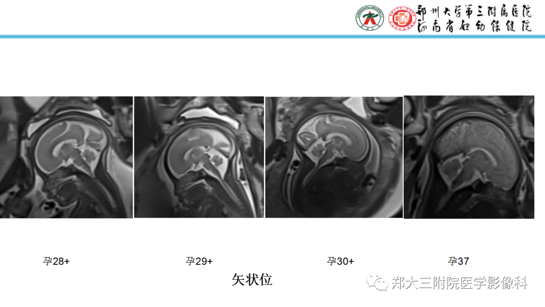 影像PPT - 【PPT】正常胎儿小脑胚胎发育及常见疾病异常发育过程-6