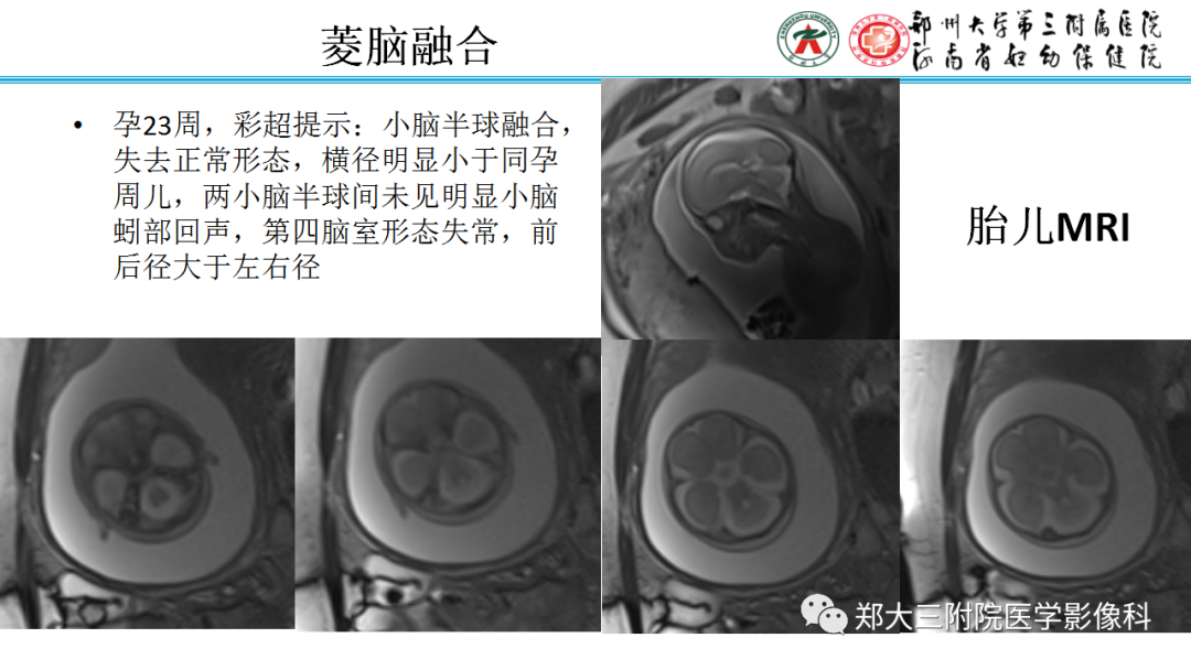 影像PPT - 【PPT】正常胎儿小脑胚胎发育及常见疾病异常发育过程-14