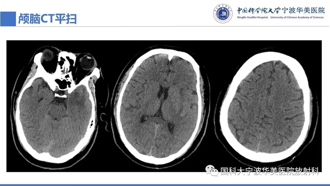 影像PPT - 【PPT】颅内结核-8