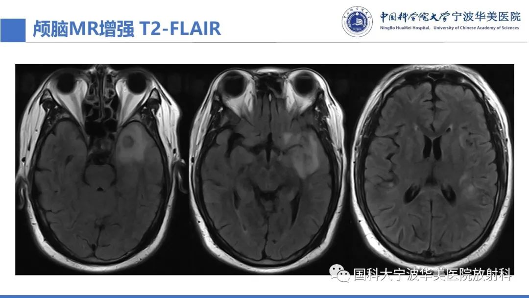 影像PPT - 【PPT】颅内结核-10