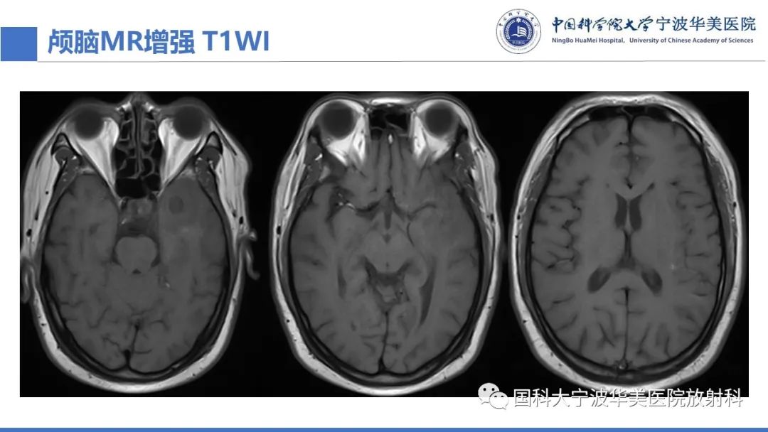 影像PPT - 【PPT】颅内结核-11