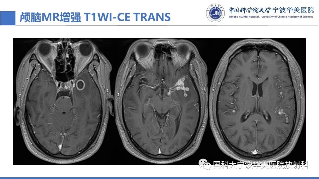 影像PPT - 【PPT】颅内结核-12
