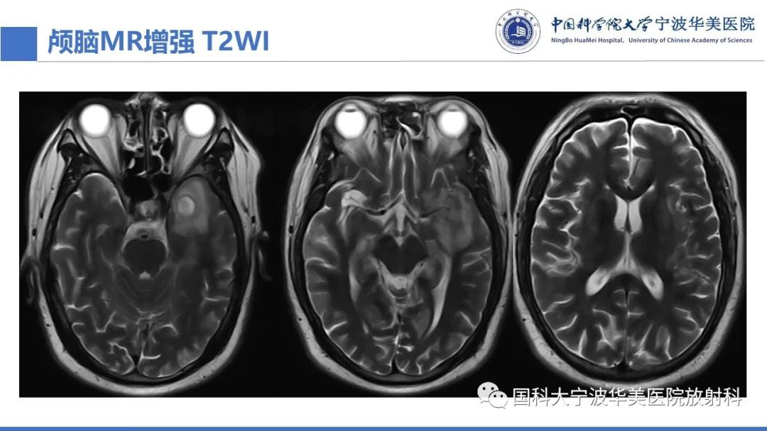 影像PPT - 【PPT】颅内结核-9