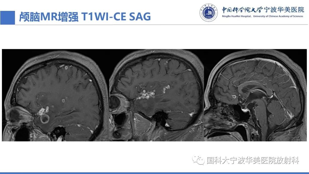 影像PPT - 【PPT】颅内结核-13