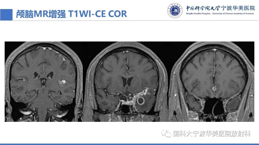 影像PPT - 【PPT】颅内结核-14