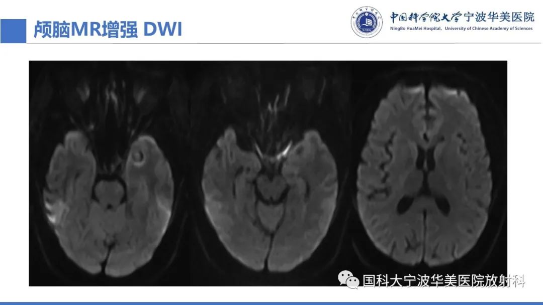 影像PPT - 【PPT】颅内结核-15