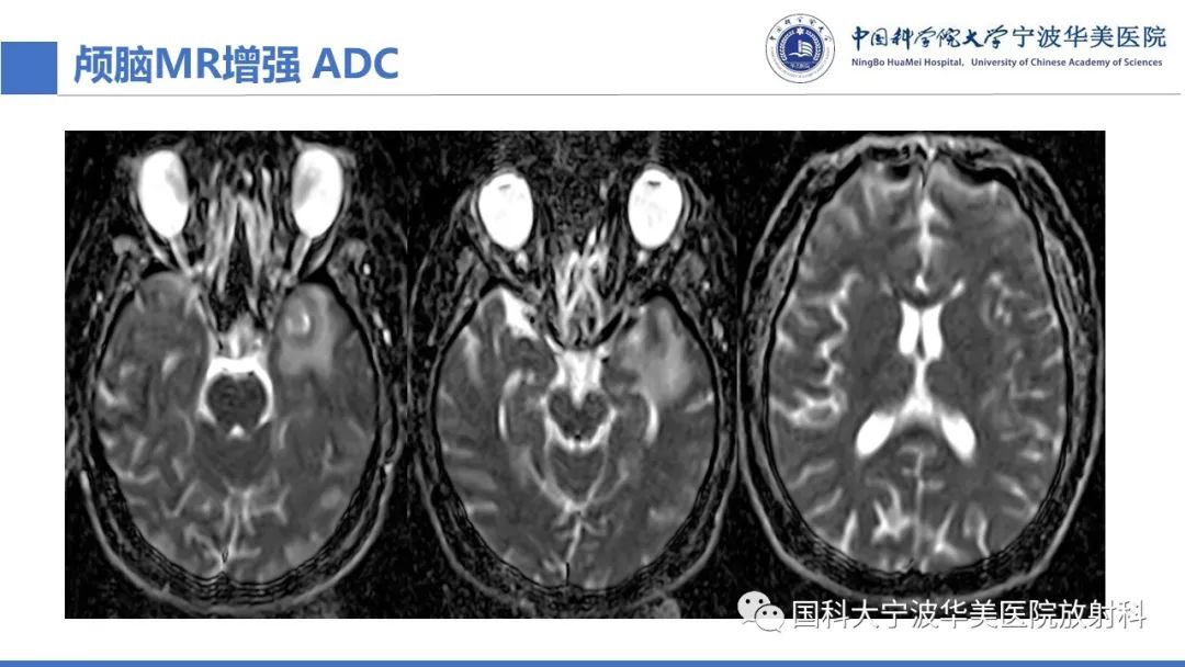 影像PPT - 【PPT】颅内结核-16