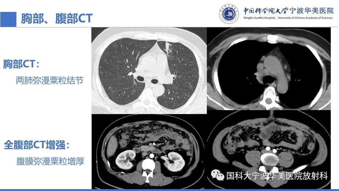 影像PPT - 【PPT】颅内结核-17