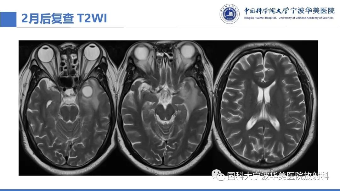 影像PPT - 【PPT】颅内结核-23