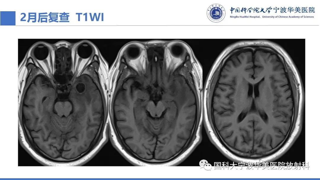 影像PPT - 【PPT】颅内结核-25