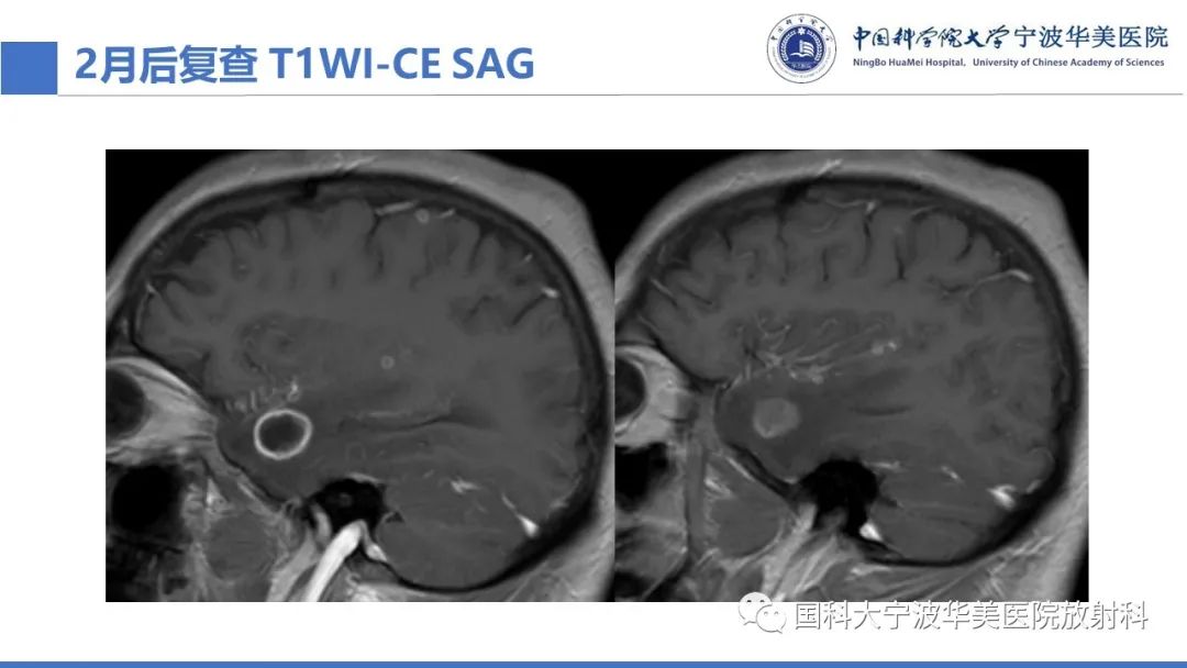 影像PPT - 【PPT】颅内结核-27