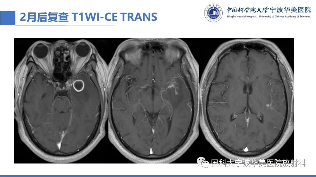 影像PPT - 【PPT】颅内结核-26