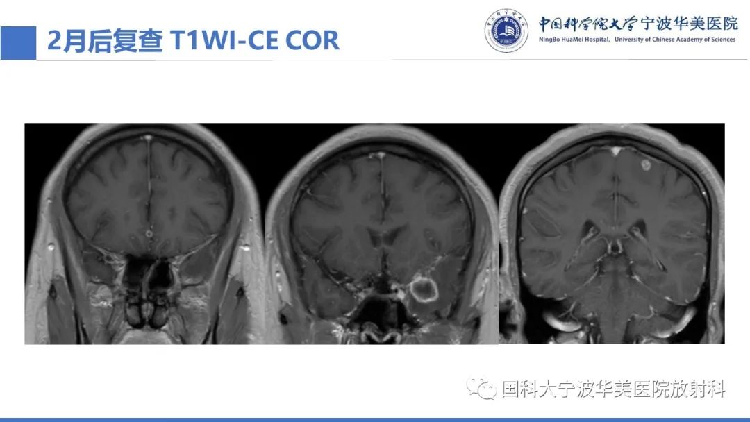 影像PPT - 【PPT】颅内结核-28