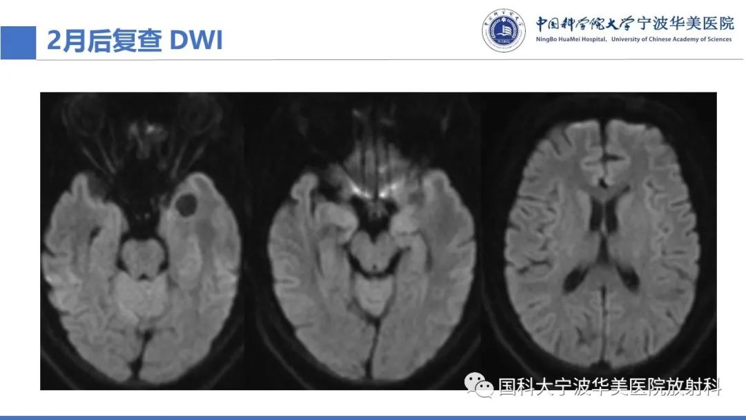 影像PPT - 【PPT】颅内结核-29