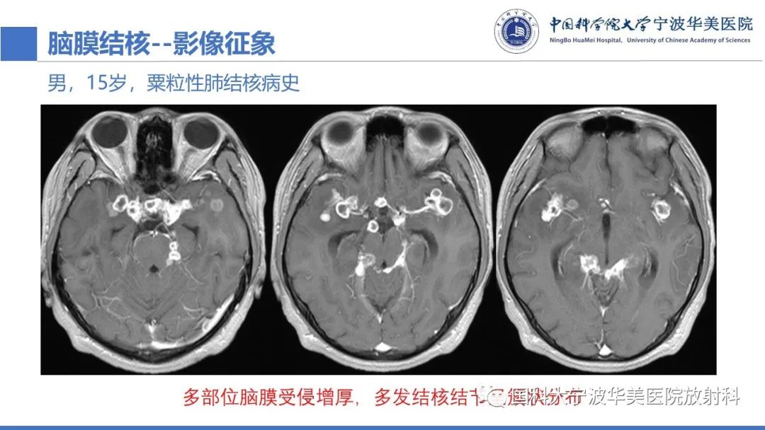 影像PPT - 【PPT】颅内结核-38