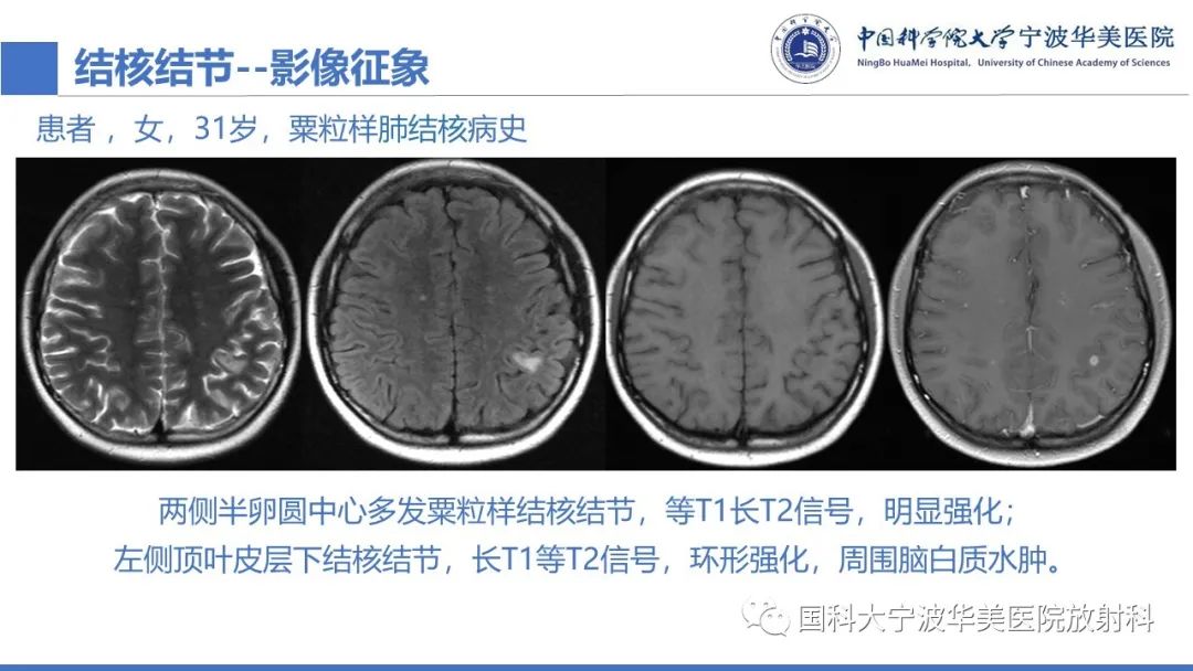 影像PPT - 【PPT】颅内结核-40