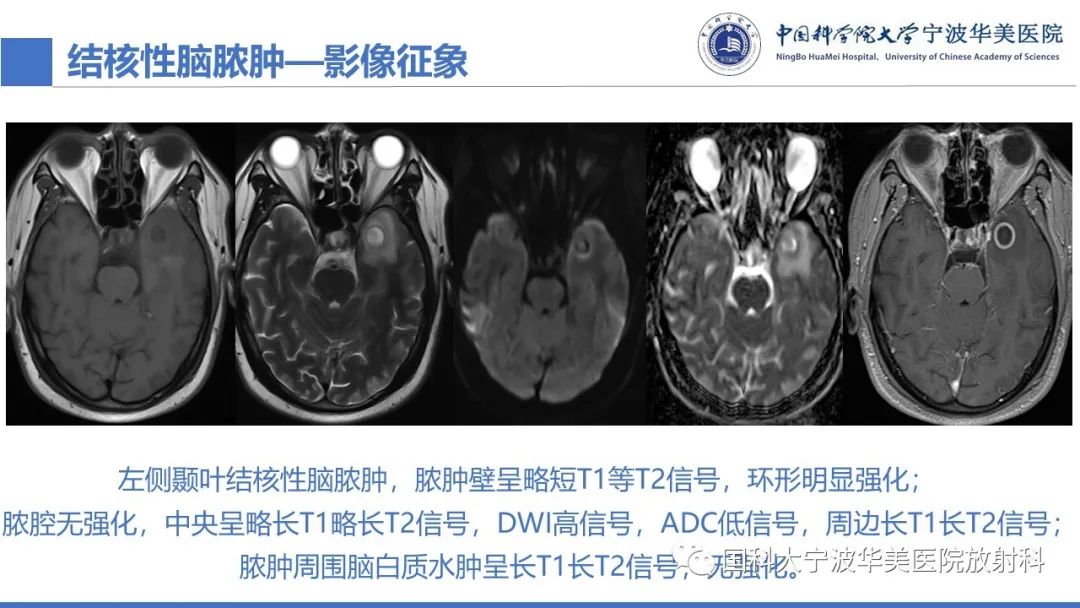 影像PPT - 【PPT】颅内结核-41