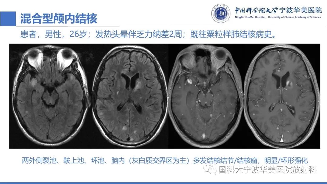 影像PPT - 【PPT】颅内结核-42