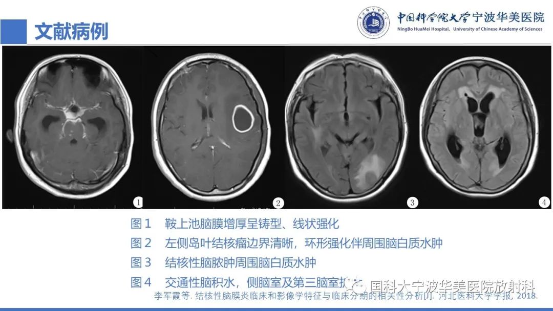 影像PPT - 【PPT】颅内结核-43