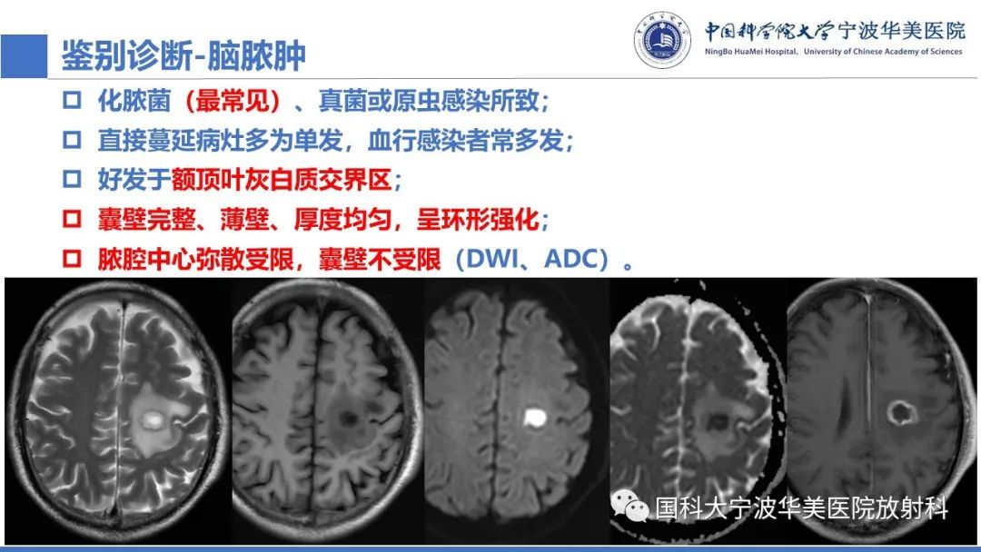 影像PPT - 【PPT】颅内结核-44