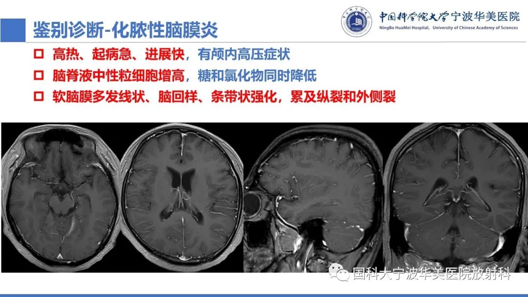 影像PPT - 【PPT】颅内结核-45