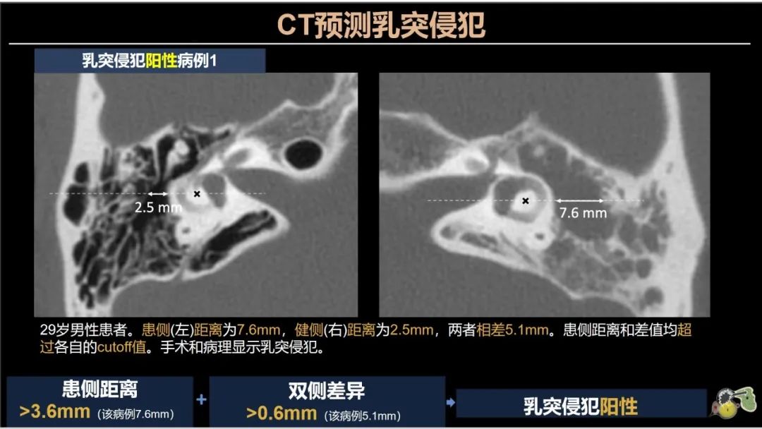 影像PPT - 【PPT】影像学方法术前预测中耳胆脂瘤的乳突侵犯-7