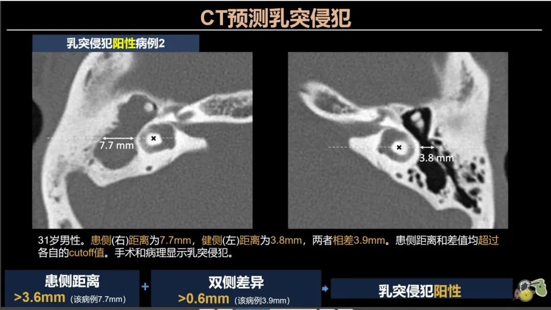 影像PPT - 【PPT】影像学方法术前预测中耳胆脂瘤的乳突侵犯-9