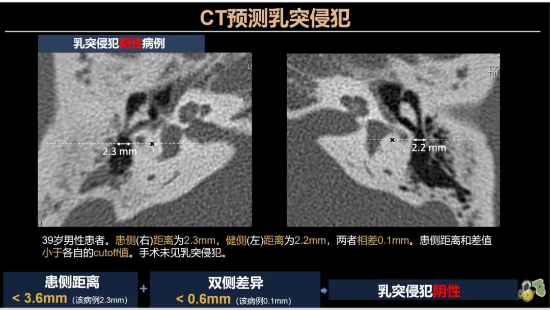 影像PPT - 【PPT】影像学方法术前预测中耳胆脂瘤的乳突侵犯-11