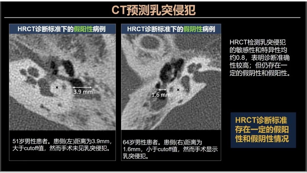 影像PPT - 【PPT】影像学方法术前预测中耳胆脂瘤的乳突侵犯-13