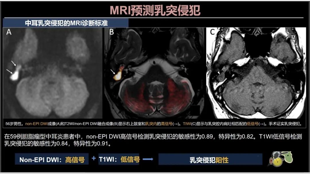 影像PPT - 【PPT】影像学方法术前预测中耳胆脂瘤的乳突侵犯-17
