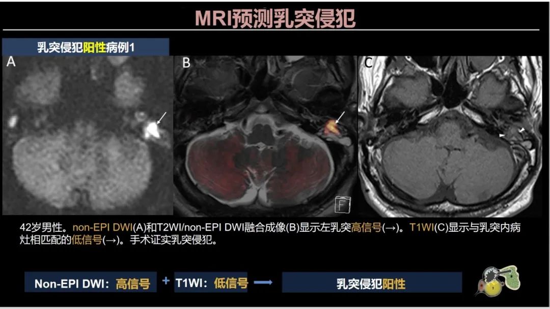 影像PPT - 【PPT】影像学方法术前预测中耳胆脂瘤的乳突侵犯-19