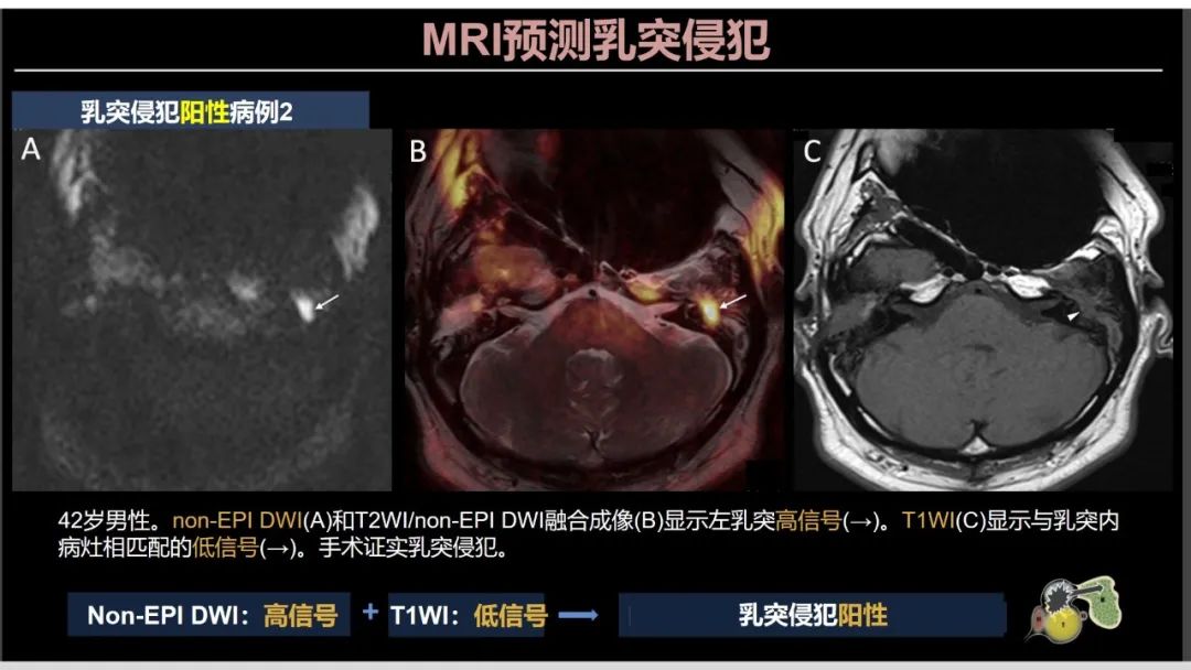 影像PPT - 【PPT】影像学方法术前预测中耳胆脂瘤的乳突侵犯-21