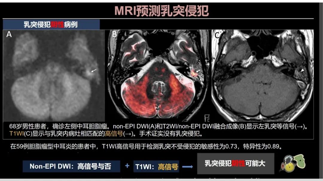 影像PPT - 【PPT】影像学方法术前预测中耳胆脂瘤的乳突侵犯-23
