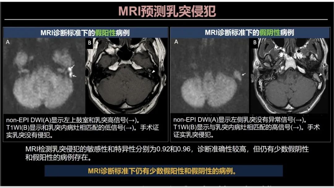 影像PPT - 【PPT】影像学方法术前预测中耳胆脂瘤的乳突侵犯-25