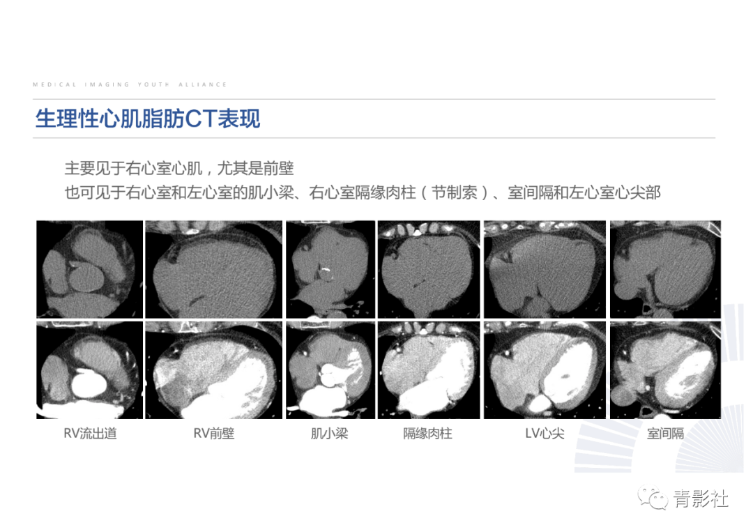 影像PPT - 【PPT】心脏脂肪临床意义和分析思路-15
