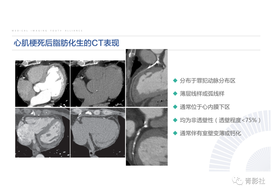 影像PPT - 【PPT】心脏脂肪临床意义和分析思路-20