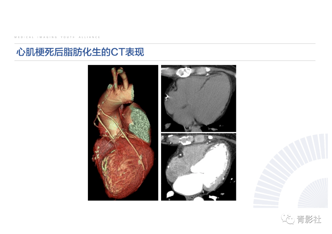 影像PPT - 【PPT】心脏脂肪临床意义和分析思路-21
