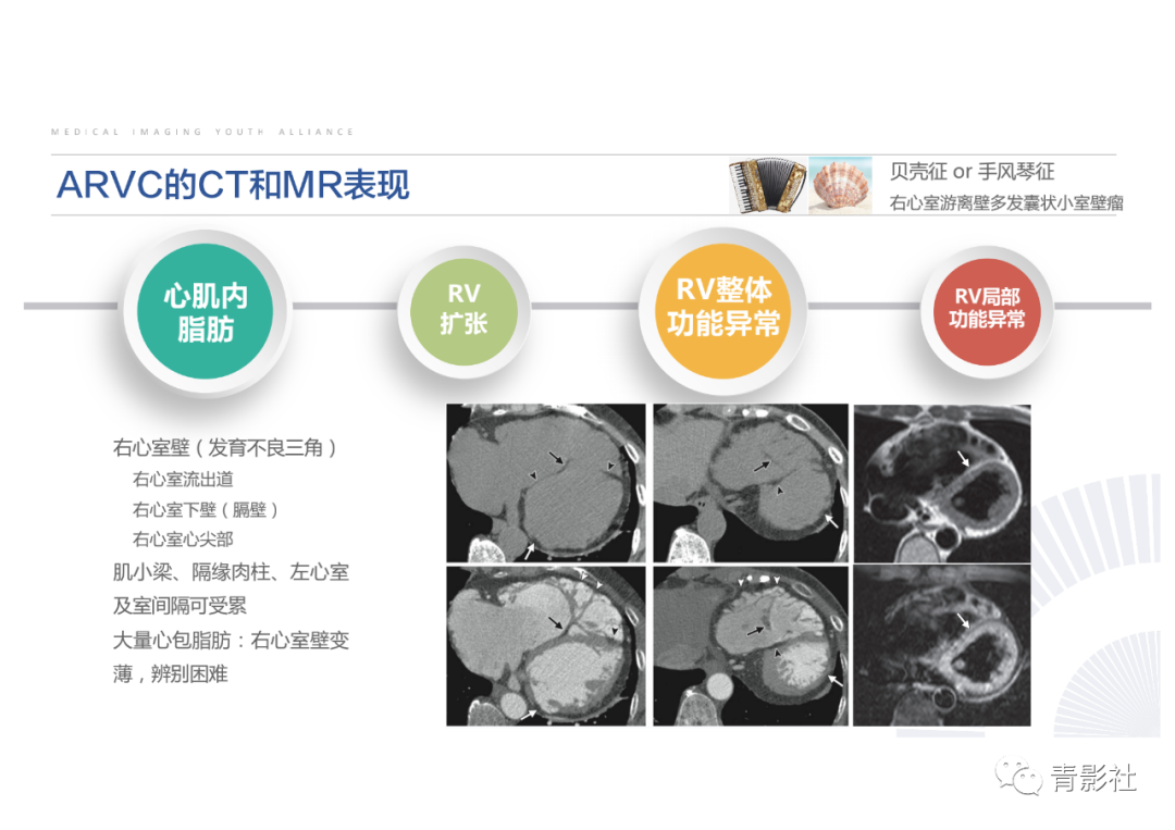 影像PPT - 【PPT】心脏脂肪临床意义和分析思路-27