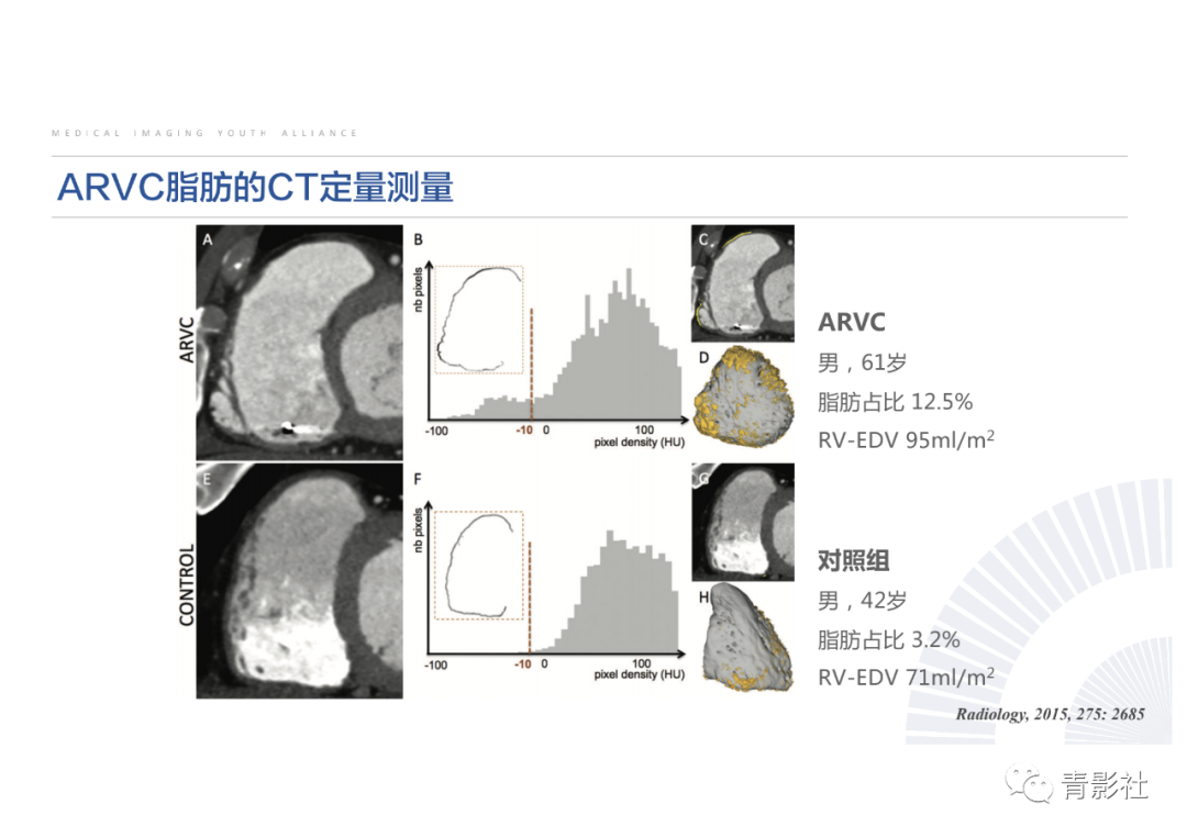影像PPT - 【PPT】心脏脂肪临床意义和分析思路-28