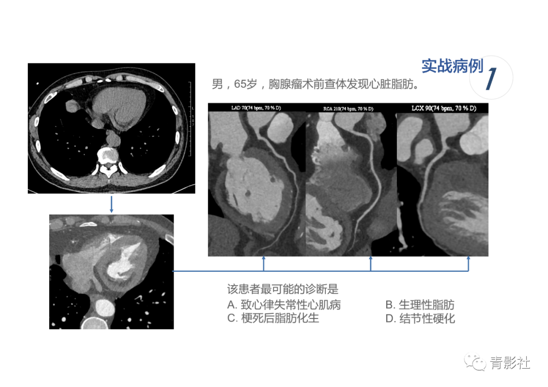 影像PPT - 【PPT】心脏脂肪临床意义和分析思路-32