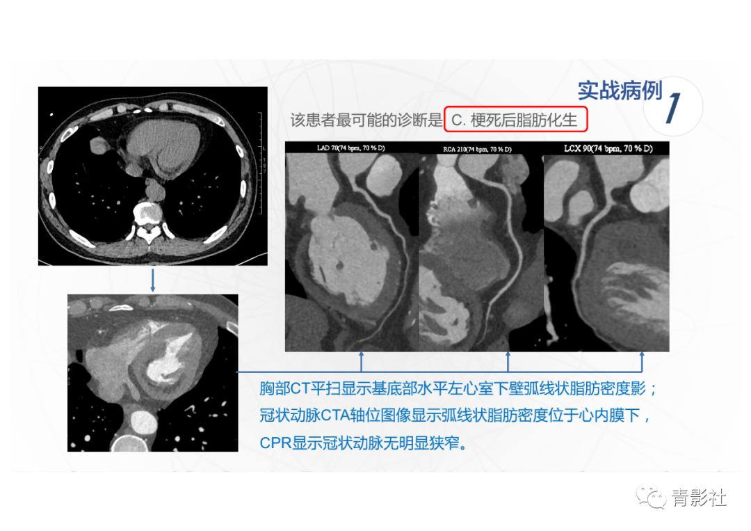影像PPT - 【PPT】心脏脂肪临床意义和分析思路-33