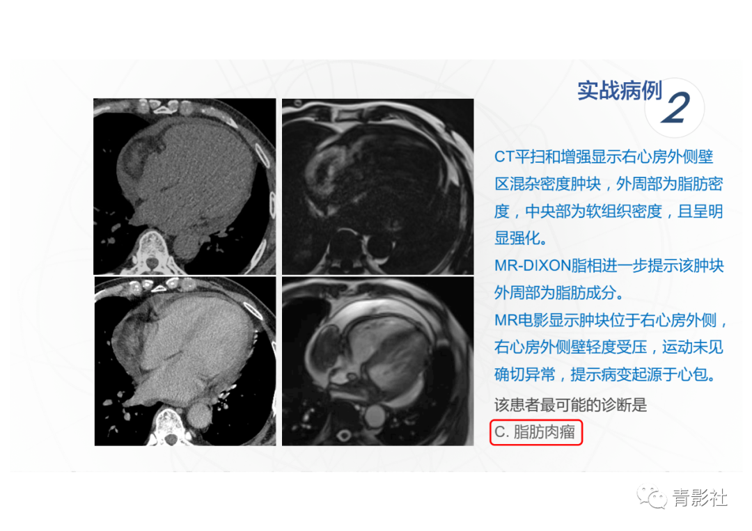 影像PPT - 【PPT】心脏脂肪临床意义和分析思路-35