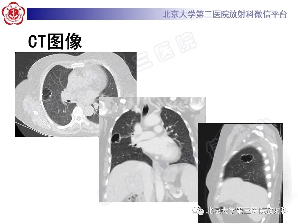 影像PPT - 【PPT】先天性肺囊性腺瘤样畸形-3