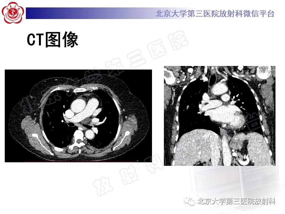 影像PPT - 【PPT】先天性肺囊性腺瘤样畸形-4